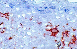 Clulas dendrticas en una lesin de leishmaniasis cutanea difusa